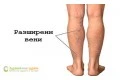 Проблеми с вените