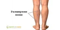 Проблеми с вените